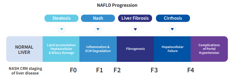 NAFLD Progression. From left to right: Normal Liver | Steatosis; Lipid accumuation Heptaocellular and Biliary Damage; NASH CRN Stage of disease F0 | Nash; Inflammation & ECM Degradation; stage F1 | Liver Fibrosis; Fibrogenesis; stage F2-F3 | Cirrhosis; Hepatocellular Failure; Stage f3-f4 | Complications of portal hypertension